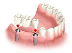 citydental hambakliiniktartus proteesimine1
